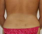 Feel Beautiful - Liposuction of Waist and Flanks - After Photo